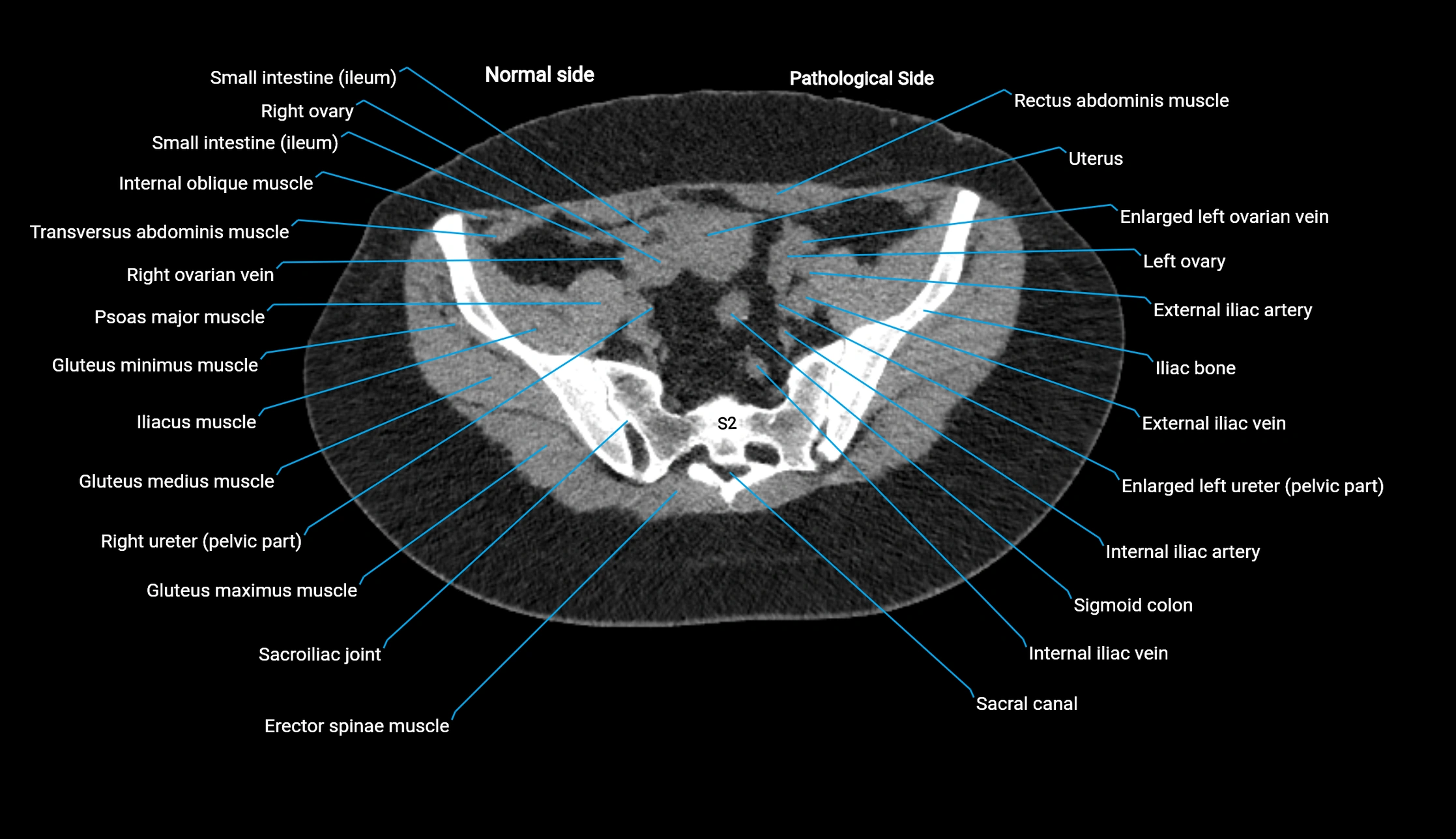 CT KUB axial cross sectional anatomy  radiology image -img-00201-00125.webp